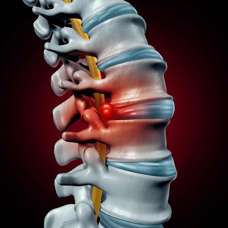 Bulging disc pressing on spinal nerve - chiropractor San Antonio TX
