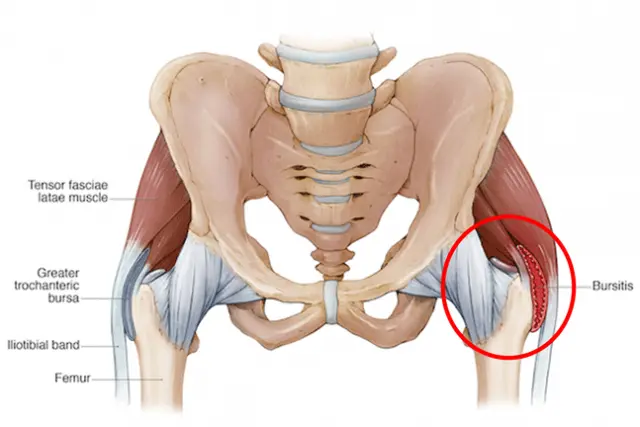 3D model showing hip bursitis joint pain - chiropractor San Antonio TX