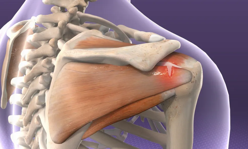 Rotator cuff tear medical image - chiropractor San Antonio TX
