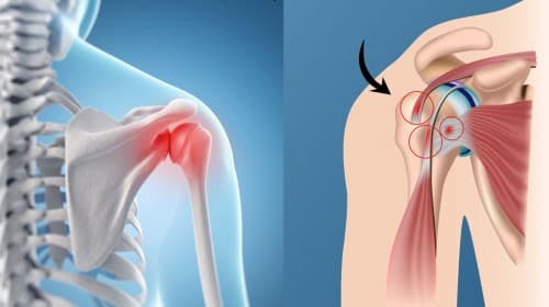 Shoulder impingement syndrome treatment - chiropractor San Antonio TX