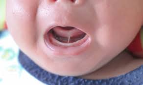 Tongue tie ankyloglossia infant pediatric chiropractor San Antonio TX
