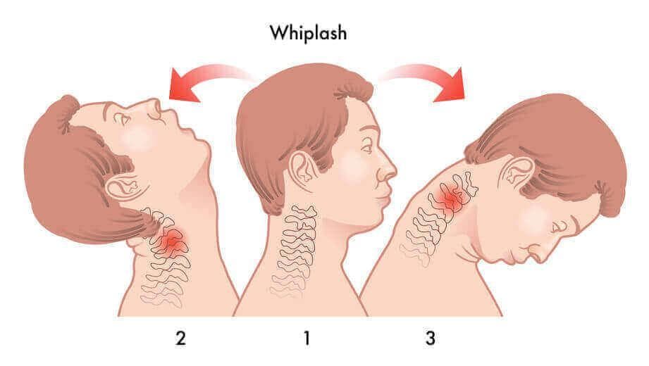 Whiplash neck injury from car accident - chiropractor San Antonio TX